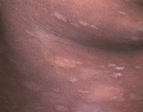 Artistic rendition of Stage IA/IB MF-CTCL as Hypopigmentation