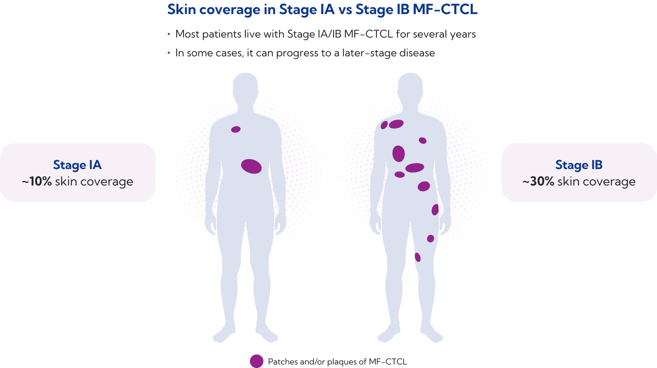 Diagram comparing Stage IA (~10% skin coverage) and Stage IB (~30% skin coverage) MF-CTCL, with patches/plaques shown in purple on two body silhouettes.