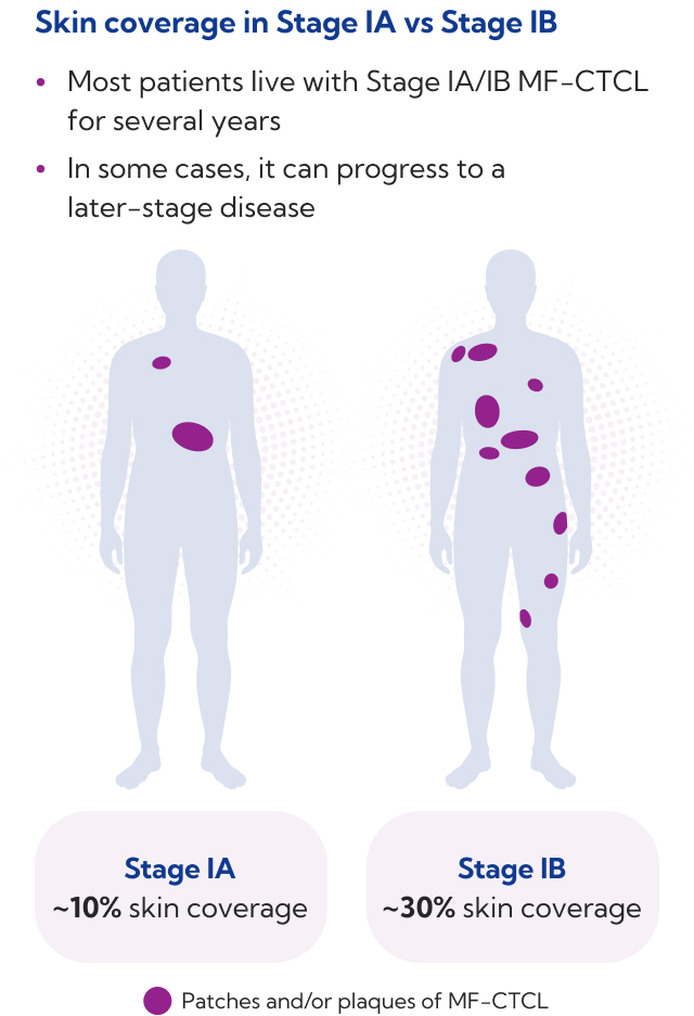 Diagram comparing Stage IA (~10% skin coverage) and Stage IB (~30% skin coverage) MF-CTCL, with patches/plaques shown in purple on two body silhouettes.
